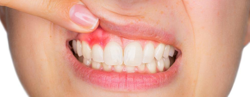 Common Myths of Gum Disease