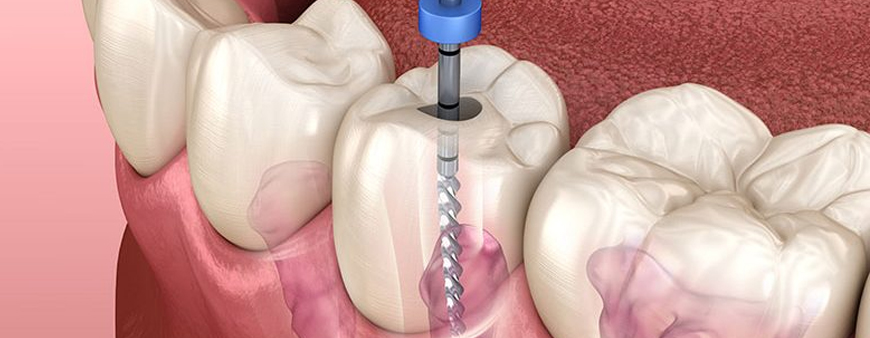 Facts to know about root canal treatment in Hyderabad