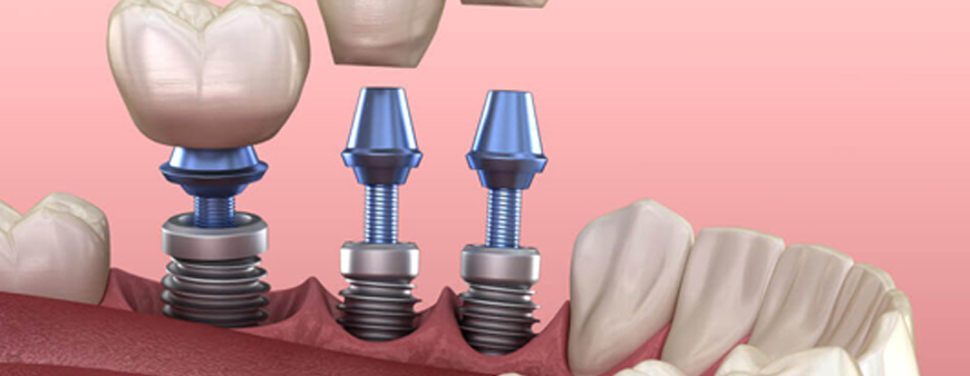 All you need to know Dental Implants Treatments in Hyderabad