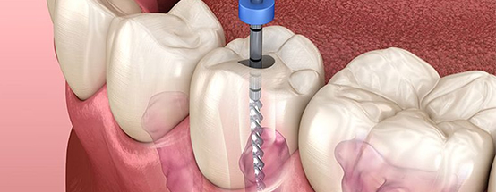 Root Canal Treatments in Hyderabad