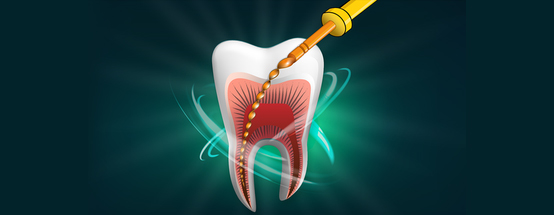 Root Canal Treatments in Hyderabad