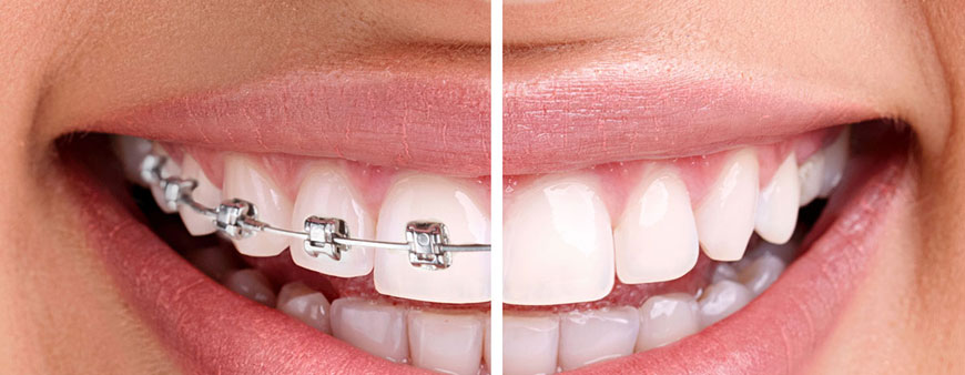 Ways to Straighten Your Teeth with Dental Braces